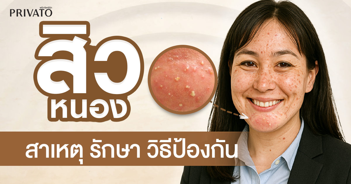 สิวหนอง