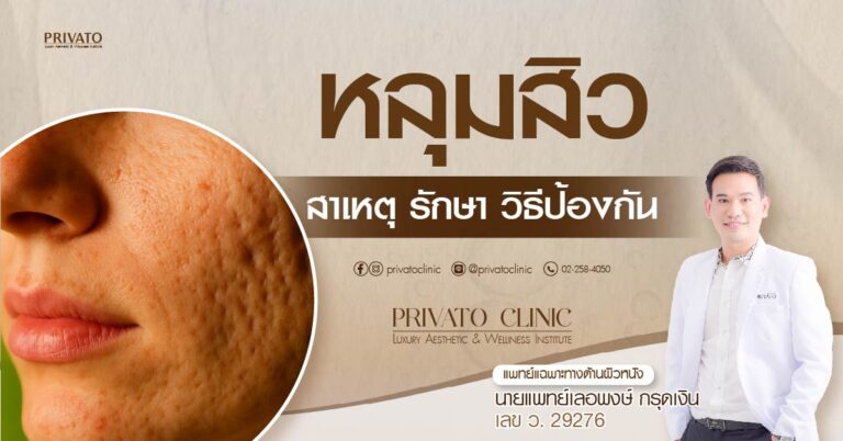 หลุมสิว: สาเหตุ ชนิด วิธีป้องกัน และแนวทางรักษาที่ได้ผล