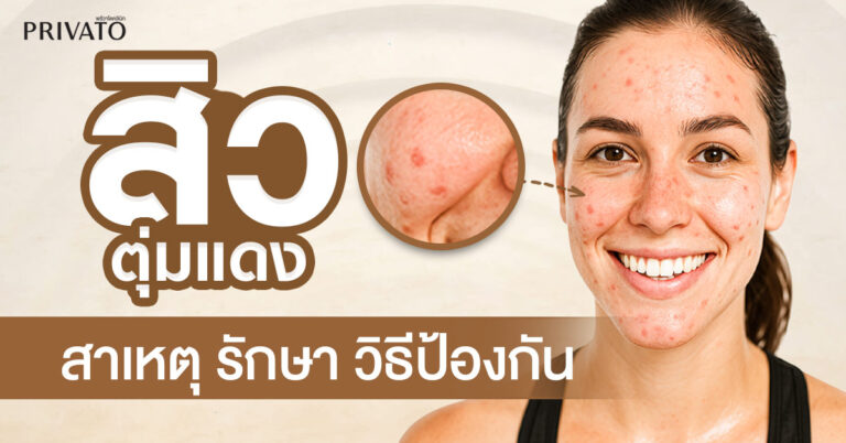สิวตุ่มแดง: สาเหตุ การรักษา และวิธีป้องกันที่ถูกต้อง