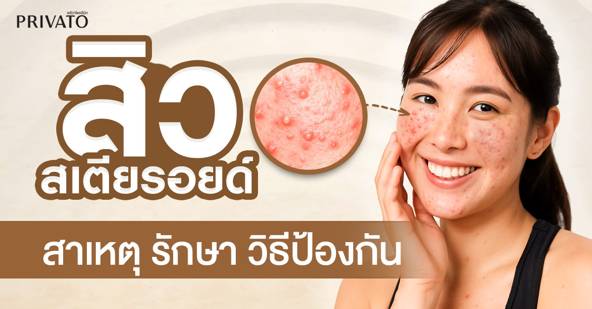 สิวสเตียรอยด์