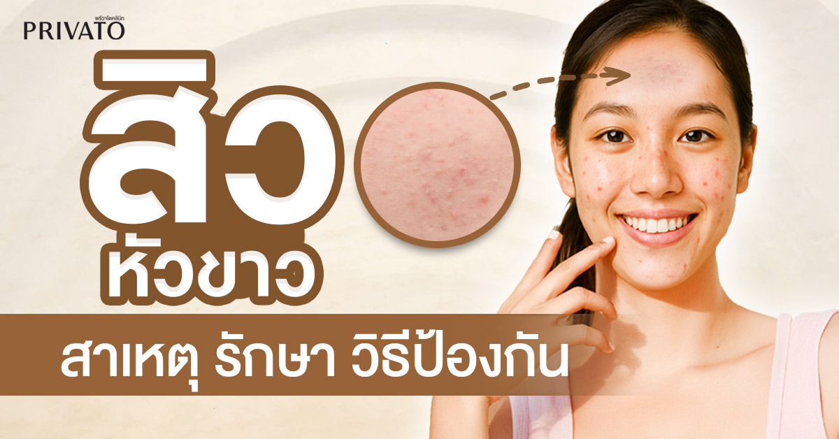 สิวหัวขาว