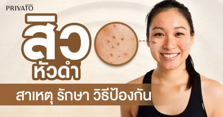 สิวหัวดำ: สาเหตุ การรักษา และวิธีป้องกันที่ถูกต้อง