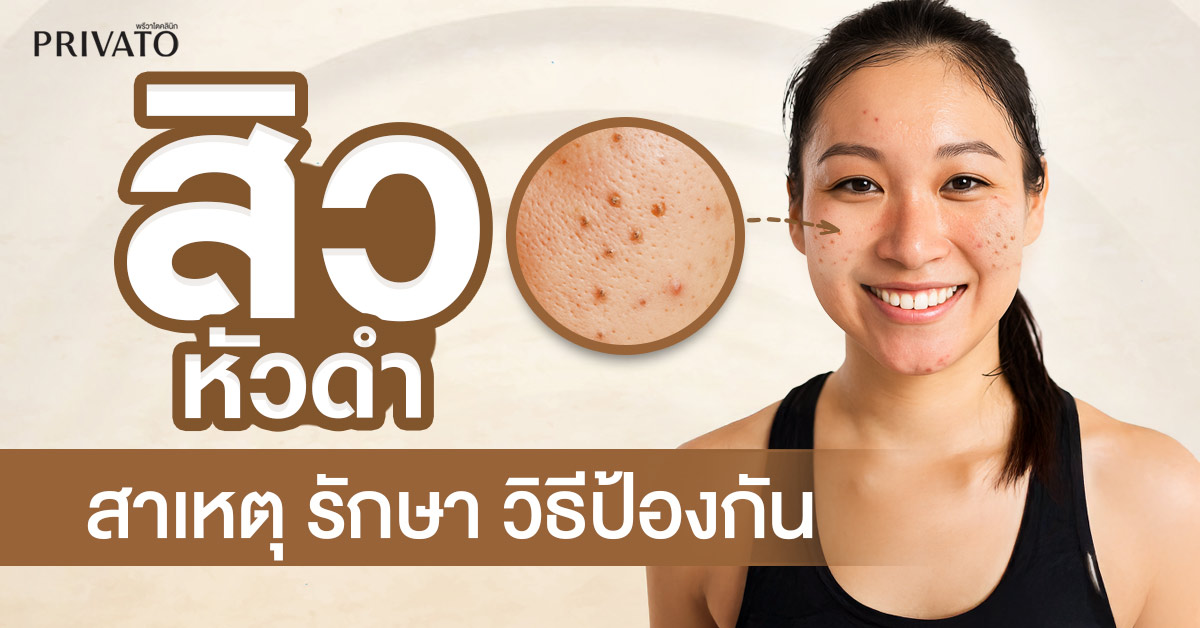 สิวหัวดำ