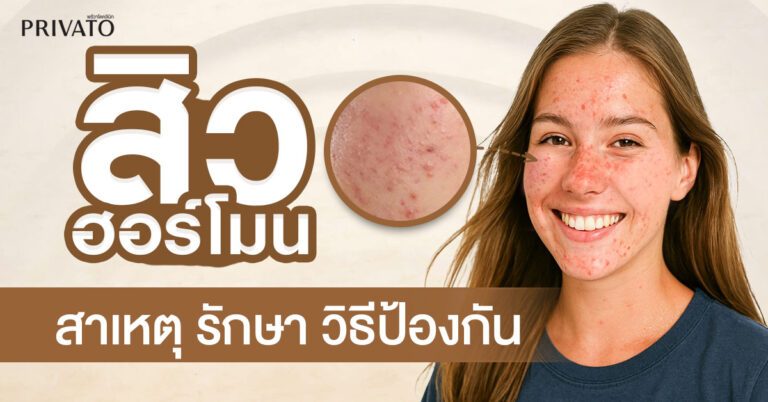 สิวฮอร์โมน: สาเหตุ การรักษา และวิธีป้องกันที่ถูกต้อง